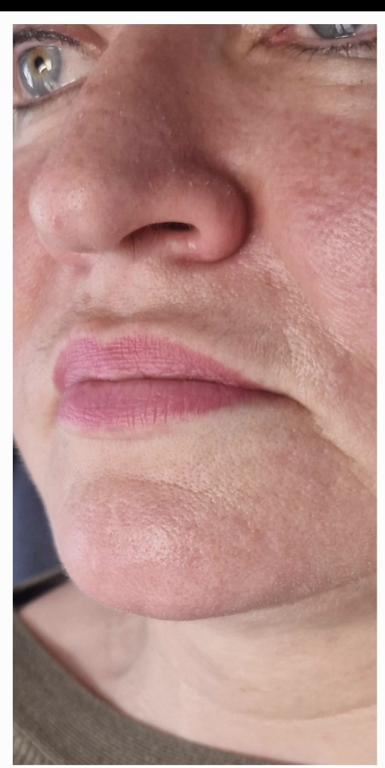 Before dermal fillers